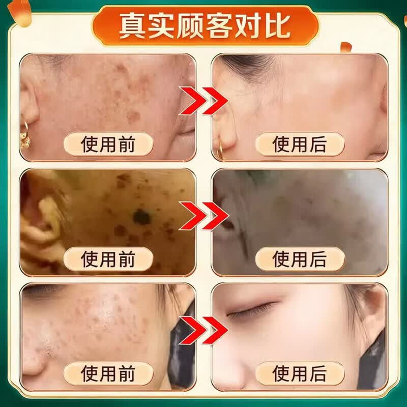 北京协和医学院祛斑霜老年斑专用特效非药一夜消去黄褐斑雀斑晒斑女士美i白用的 特效1盒【北京协和】祛斑点斑专用的药水医用级 白美淡化祛斑去黑色素黄褐雀斑晒斑男女士专用特效的药