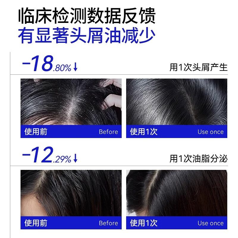 EHD二硫化硒控油去屑洗发水400ml温和清洁头皮调理头油头屑男女通用 【体验装】去屑洗发水400ml 1瓶