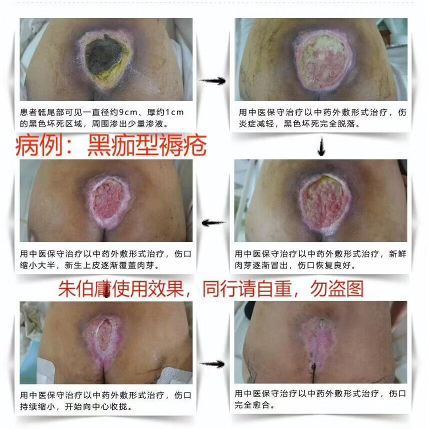 朱伯庸三黄血竭保健膏糖足膏褥疮膏卧床老人护理膏糖尿病足健字号 黑色