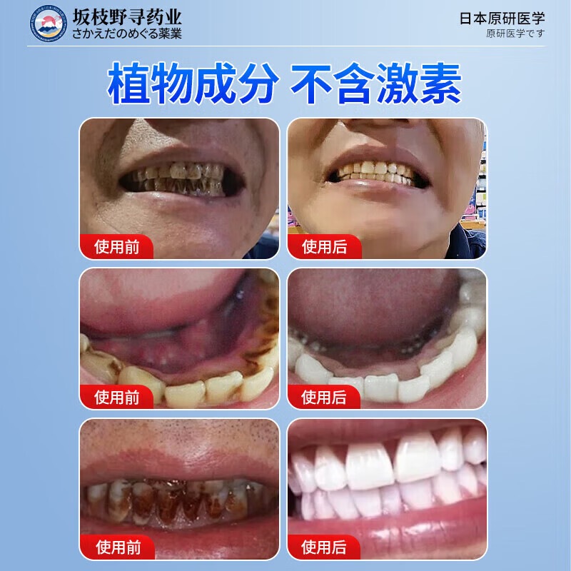 坂枝野寻漱口水便携牙结石口臭去黄牙石牙垢牙周膏炎牙渍速傚溶解清新口气 告别牙结石口臭】1瓶