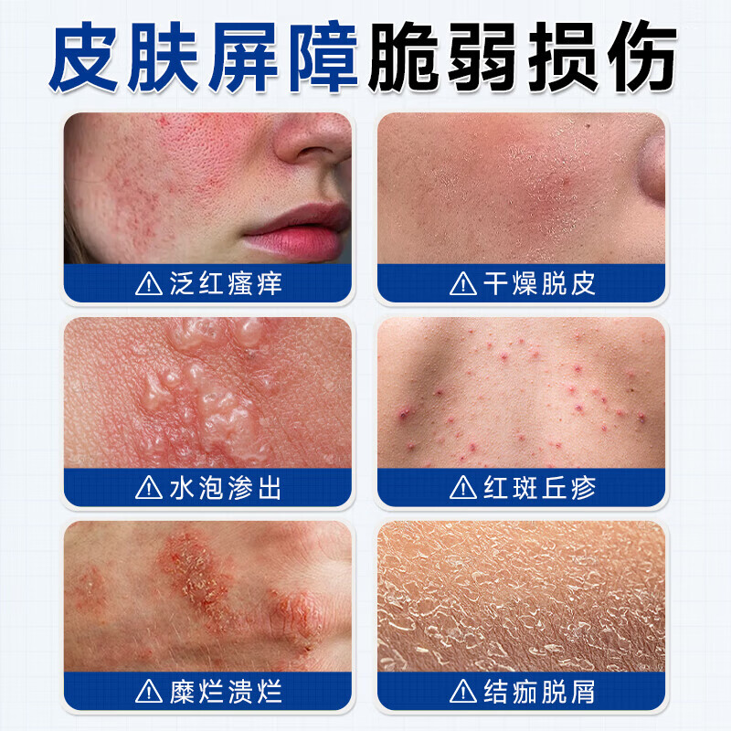 香港大药房湿疹膏搭湿疹药膏皮肤瘙痒皮炎湿疹真菌王感染止痒皮癣阴顽固湿毒 单盒【轻度湿疹】体验装