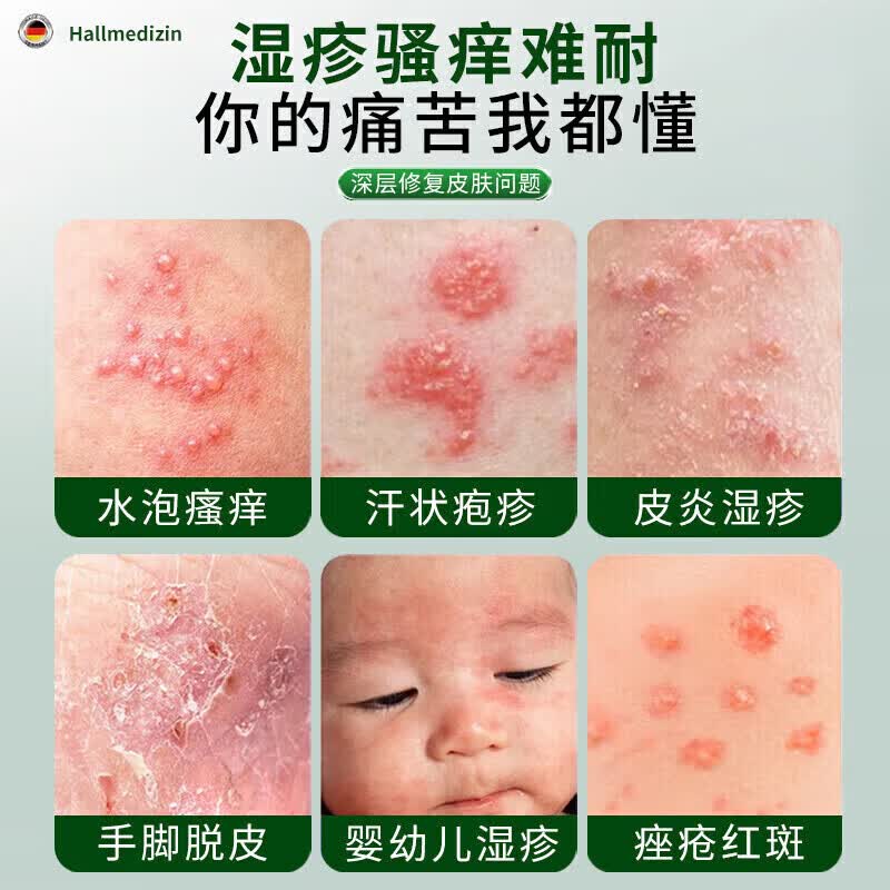 湿疹药膏十大牌子止痒抑菌皮肤瘙痒去顽固湿毒皮炎皮癣湿疹止痒膏 【德国研发】1盒 皮肤用药干裂起皮湿疹瘙痒止痒膏