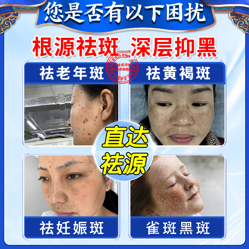 [臣功]维A酸乳膏 祛斑霜黑色素祛斑专用药黄褐斑日晒斑雀斑老年斑强力祛除手脸部消除男女专【视觉特效】 15克/支 1盒装 【标准装】