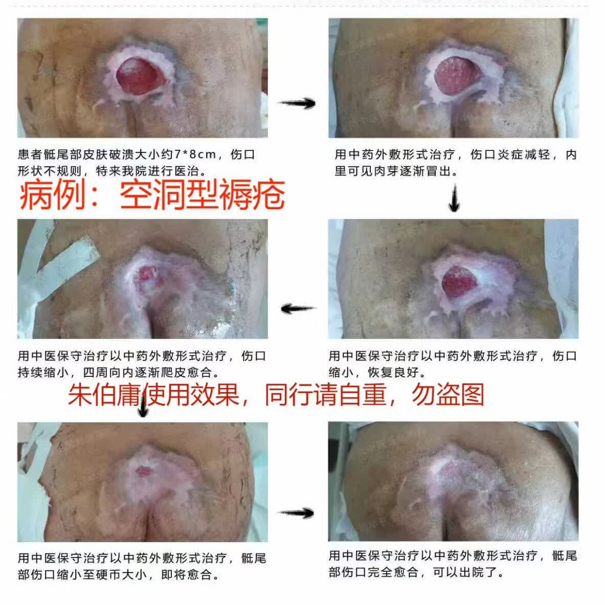 朱伯庸三黄血竭保健膏糖足膏褥疮膏卧床老人护理膏糖尿病足健字号 黑色