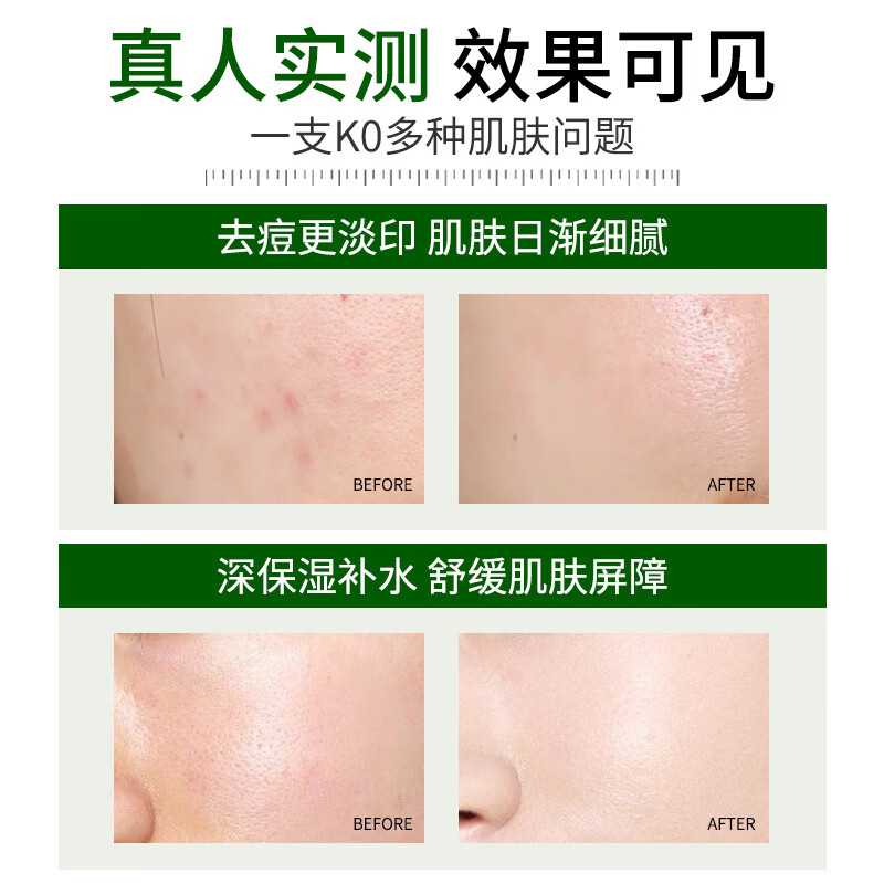 MRYU积雪苷霜乳膏软膏去除黑色素轻朴复颜舒缓膏保湿霜淡化痘印舒缓嫩 【买2送1】3盒 周期装 官方直售 京质保障