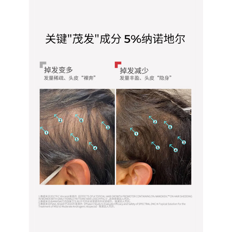 MRYU纳诺地尔精华液DS实验室纳诺地尔头皮护理防脱育发精华液固发增密 【99%的顾客选择】买三赠二 5瓶装 【官方旗舰 京质保障】
