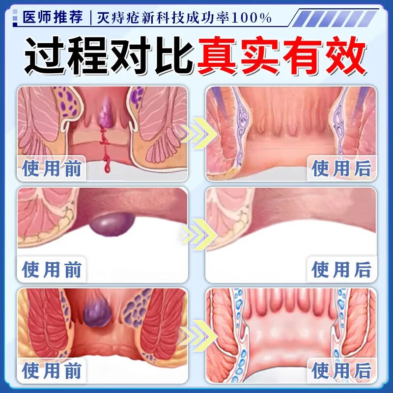 今古透痔疮膏 100%特效:5+4【已帮助2w+患者】 痔疮膏内外混合痔疮丨重度庤疮药膏消痔凝胶去肉球
