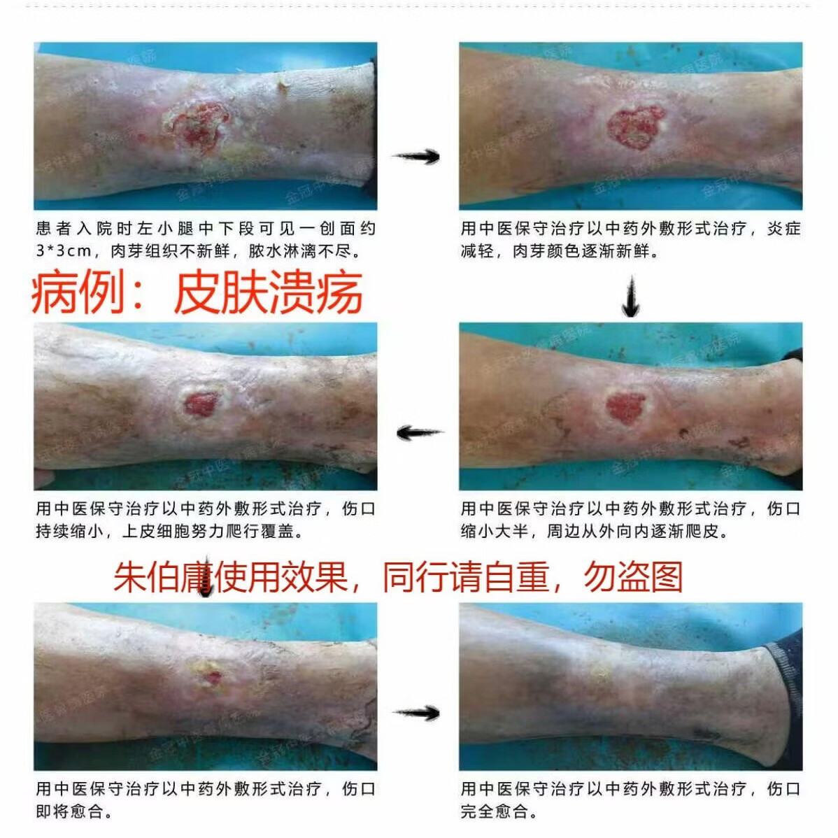 朱伯庸三黄血竭保健膏糖足膏褥疮膏卧床老人护理膏糖尿病足健字号 黑色