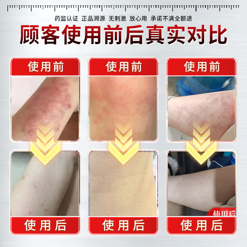 伊藤薬制日本炉甘石抑菌止痒皂全身瘙痒湿痒湿诊真菌感染止痒皂全身体适用 一盒【日本进口】炉甘石抑菌止痒膏 炉甘石软膏婴儿儿童止痒乳膏湿疹热疹