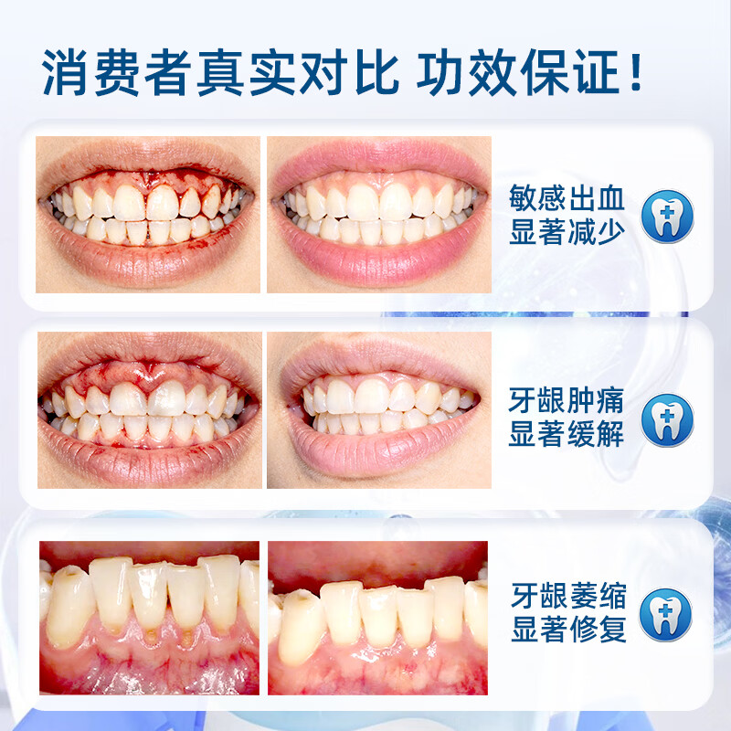 李时珍牙科分离剂牙膏状牙龈萎缩牙齿松动固齿修复再生牙周炎敏感肿痛药 5盒巩固装【官方旗舰】肿痛出血护龈固齿