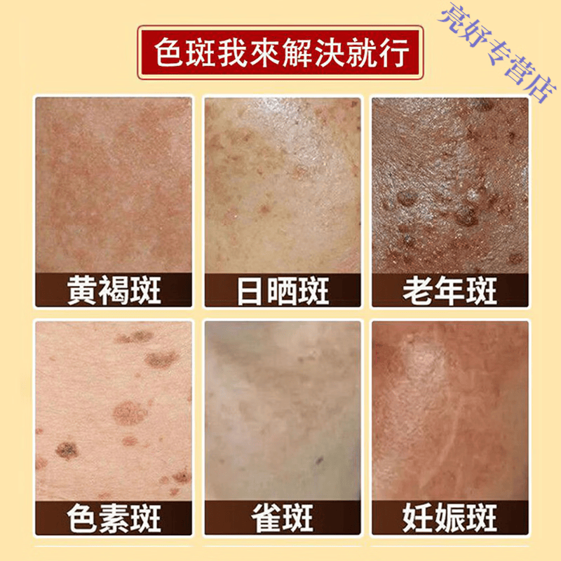 BEIYVS印度檀香木祛斑皂进口祛黄褐斑美白老年斑强力去除一夜消不留疤 五块装【滋润亮白】买三送二 官方直售 京质保障