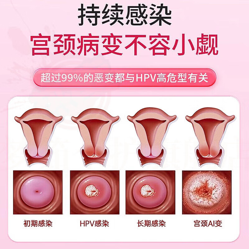 思亚希金波抗hpv病毒生物蛋白敷料蛋白妇科专特用效阴道宫颈炎瘙痒疼痛 九盒【抗HPV 已恢复老客户巩固装】拍7发9 官方直售