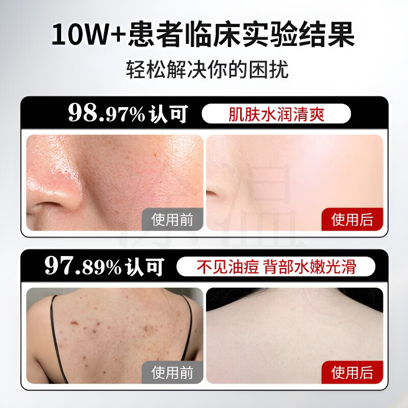 MRYU上海硫磺皂除螨去螨虫后背痘痘祛痘脸部医用杀菌止痒阴虱牛黄除螨 买一送一【古法净澈装】油痘救星