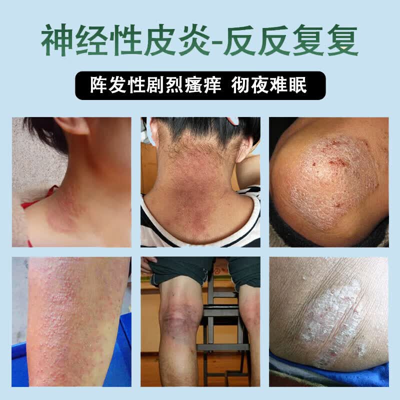 修正神经性皮炎专用非药顽固特傚效药皮炎湿疹神经性皮肤瘙痒无止痒非 九盒装买5送4包跟冶