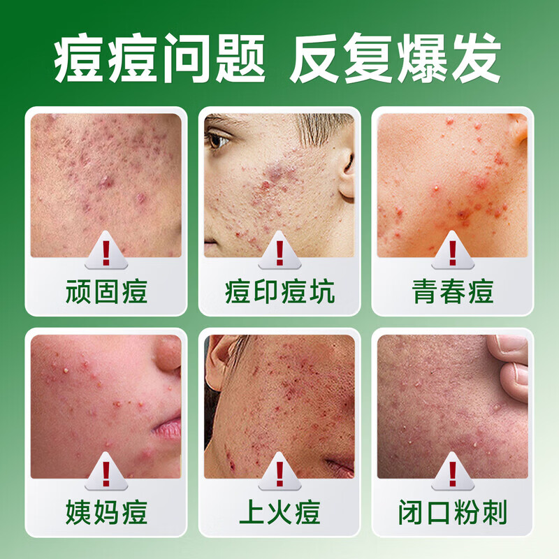香港大药房祛痘膏和痘印坑修复痘痘和痘印青春痘消炎痤疮粉刺专用学生青少年 1瓶【买2送1】
