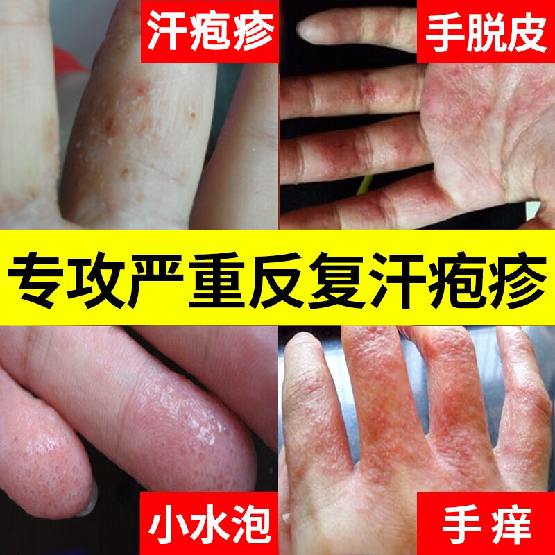 汗疱疹汗泡疱疹药膏汗孢疹去手上起小水泡手痒汗状湿疹止痒乳膏 拍1件发3盒(粉色乳膏)