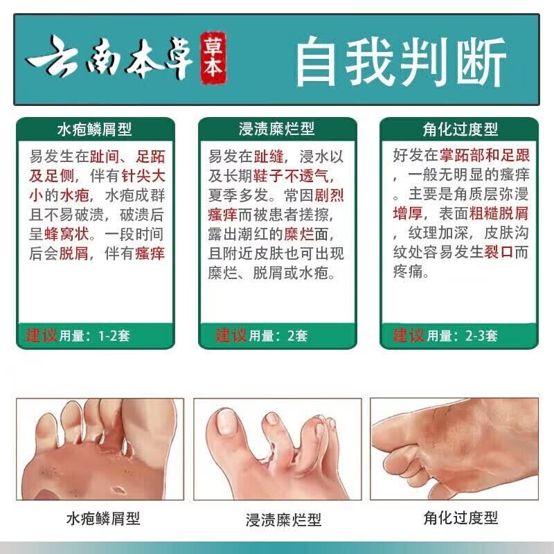 寓福堂脚气喷剂真菌感染水泡烂脚丫喷雾脚臭脚痒药足部抑菌杀菌止痒喷剂 中度脚气60ml【三瓶装】