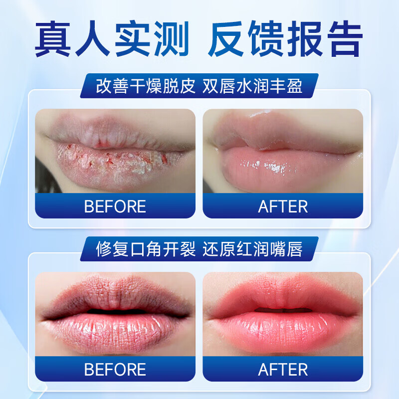 KERLY麦美舒唇炎唇膏唇部医用凝胶新芭安干裂保湿医用退热凝唇干皮肿红 【重度唇炎3支装】 药房直售