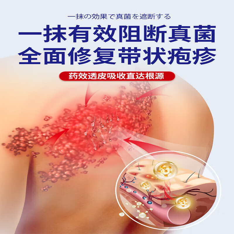 德国带状疱疹后遗症神经痛专用喷剂蛇盘疮蛇缠腰疱疹止痒止疼效药 1盒30ml 蛇盘疮后遗症神经痛止痒痛的药膏
