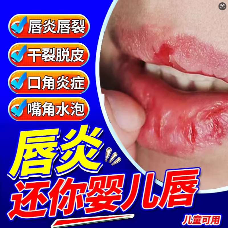 KERLY麦美舒唇炎唇膏唇部医用凝胶新芭安干裂保湿医用退热凝唇干皮肿红 【重度唇炎3支装】 药房直售