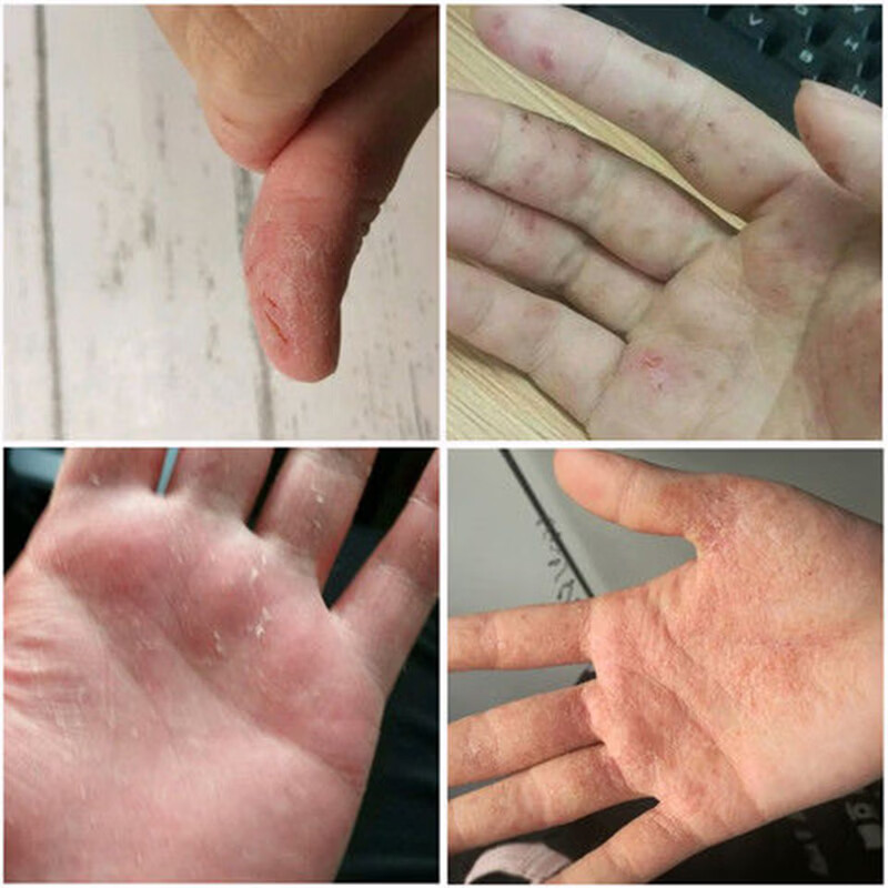 汗疱疹汗泡疱疹药膏汗孢疹去手上起小水泡手痒汗状湿疹止痒乳膏 拍1件发3盒(粉色乳膏)