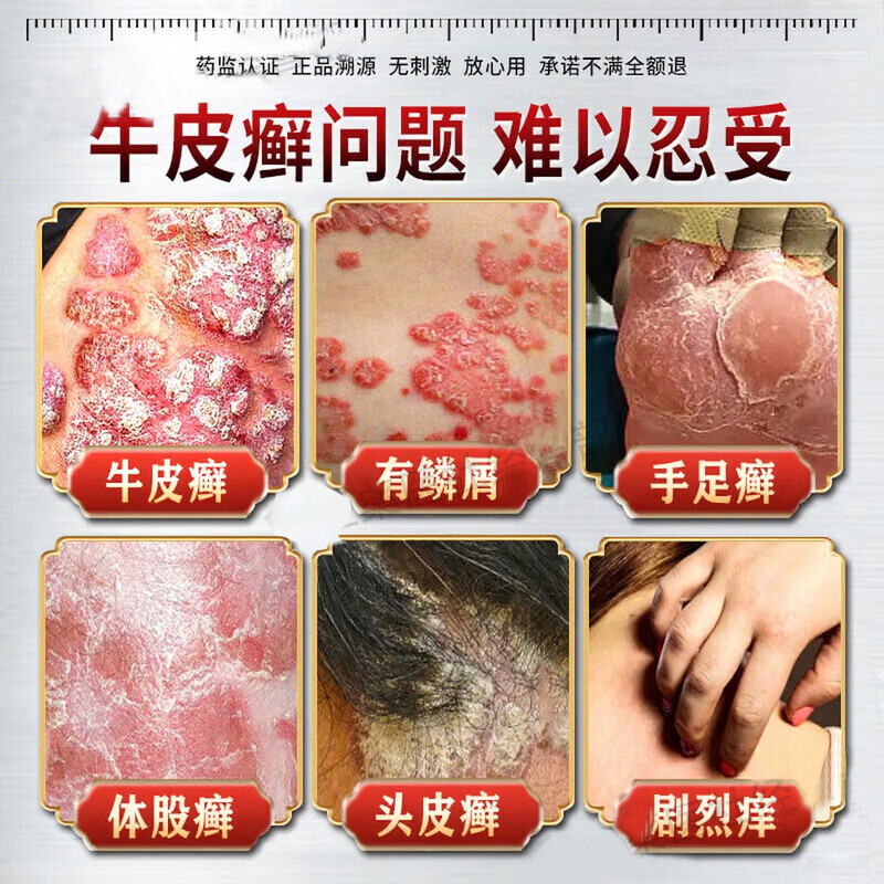 北京协和医学院银屑病药膏生物制剂针顽固皮癣专用真菌止痒皮肤治瘙痒断i根药膏 特强效1盒【一抹見效】原装正品 银屑病牛皮癣皮肤癣专用特强效膏