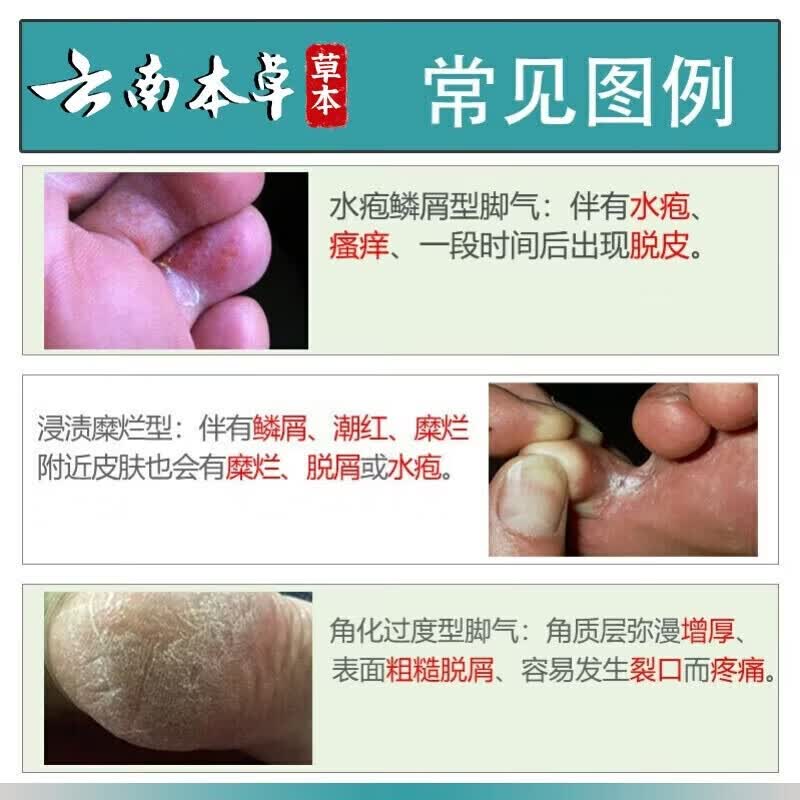 寓福堂脚气喷剂真菌感染水泡烂脚丫喷雾脚臭脚痒药足部抑菌杀菌止痒喷剂 中度脚气60ml【三瓶装】