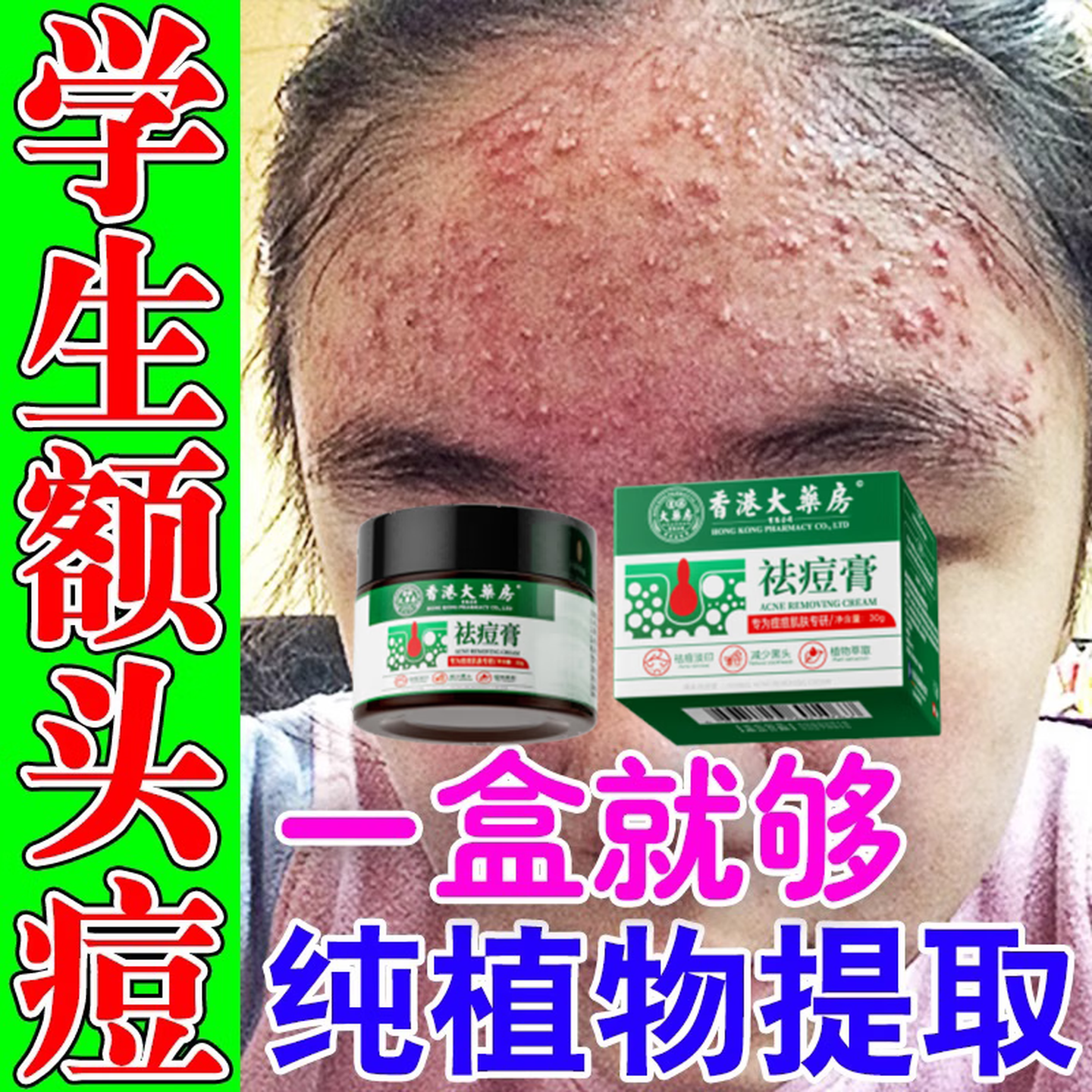 香港大药房祛痘膏和痘印坑修复痘痘和痘印青春痘消炎痤疮粉刺专用学生青少年 1瓶【买2送1】