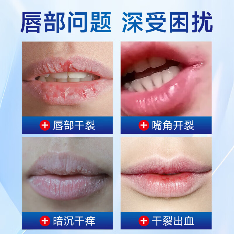 KERLY麦美舒唇炎唇膏唇部医用凝胶新芭安干裂保湿医用退热凝唇干皮肿红 【重度唇炎3支装】 药房直售