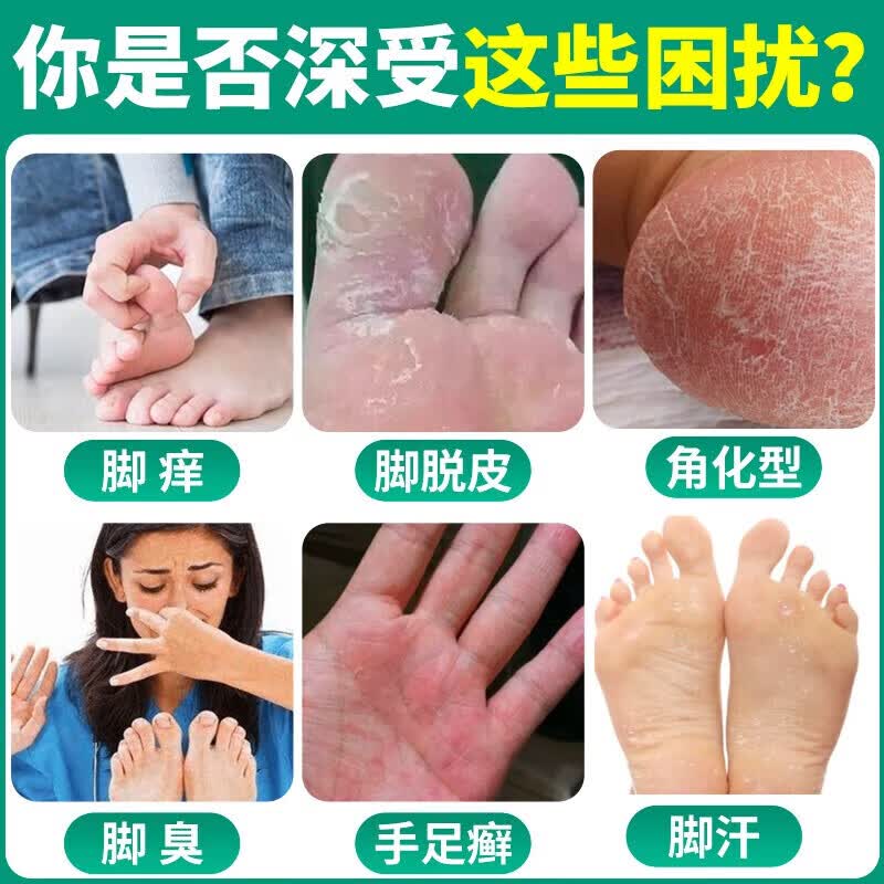 [九芝堂]盐酸特比萘芬喷雾剂 1%*40ml 1盒装 脚气喷雾剂脚气药止痒脱皮烂脚丫真菌感染脚臭脚气专用药乳膏手癣足癣股癣 轻度 半疗程
