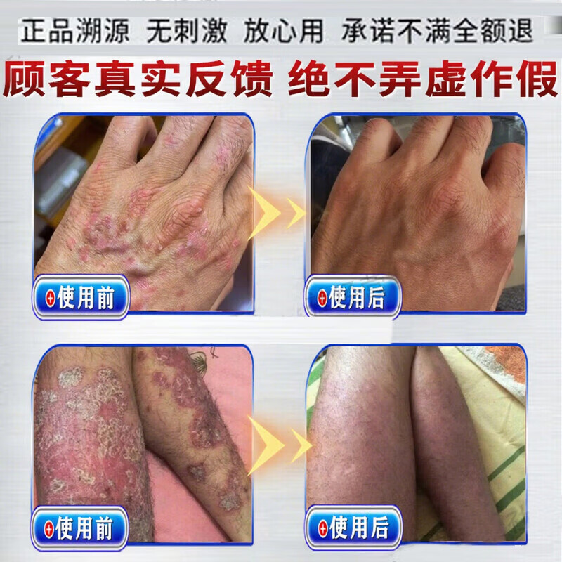 北京协和医学院银屑病药膏生物制剂针顽固皮癣专用真菌止痒皮肤治瘙痒断i根药膏 特强效1盒【一抹見效】原装正品 银屑病牛皮癣皮肤癣专用特强效膏