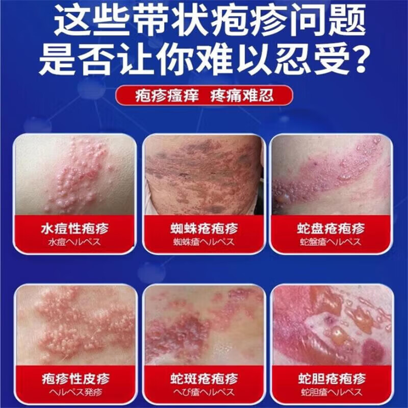 德国带状疱疹后遗症神经痛专用喷剂蛇盘疮蛇缠腰疱疹止痒止疼效药 1盒30ml 蛇盘疮后遗症神经痛止痒痛的药膏