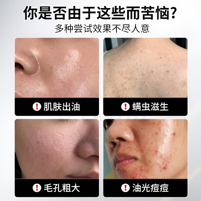 MRYU上海硫磺皂除螨去螨虫后背痘痘祛痘脸部医用杀菌止痒阴虱牛黄除螨 买一送一【古法净澈装】油痘救星