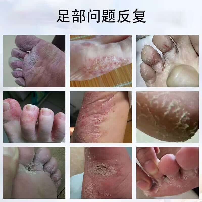 寓福堂脚气喷剂真菌感染水泡烂脚丫喷雾脚臭脚痒药足部抑菌杀菌止痒喷剂 中度脚气60ml【三瓶装】