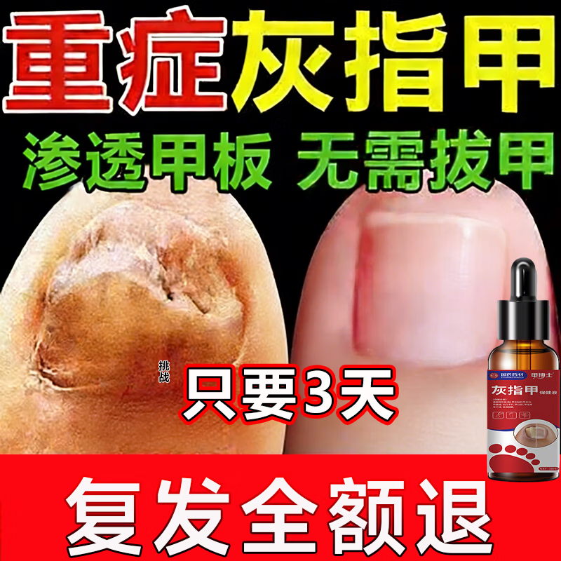 国药药材灰指甲第1名药灰指甲专用指甲真菌感染脱甲坏甲新亮甲根i治护理液 3盒装【2-5个灰甲推荐买】 京东折扣/优惠券