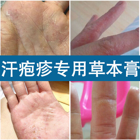 汗疱疹汗泡疱疹药膏汗孢疹去手上起小水泡手痒汗状湿疹止痒乳膏 拍1件发3盒(粉色乳膏)