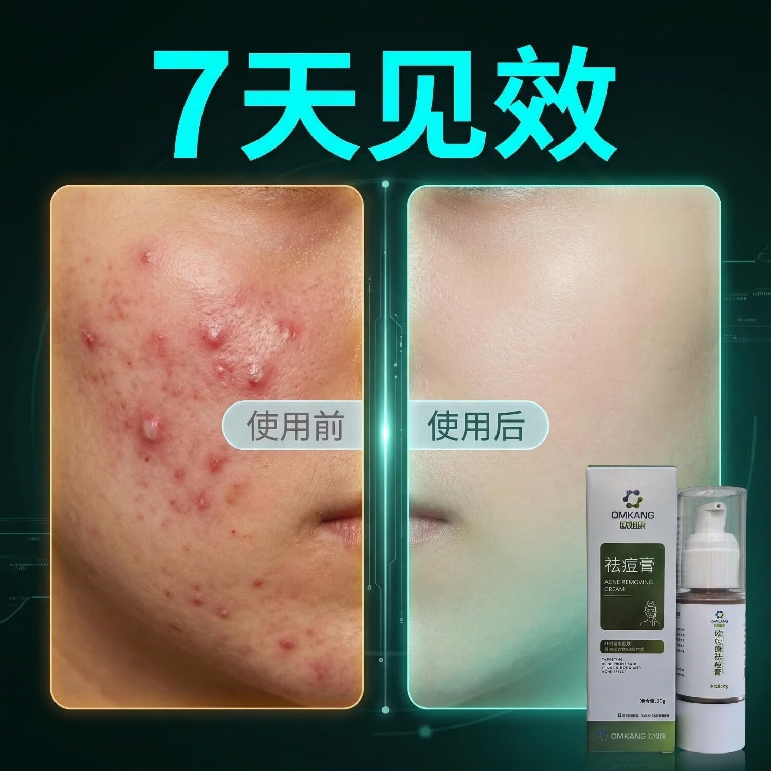 欧姆康祛痘膏专利生物炭祛痘淡化痘印痘坑修护肌肤杀菌学生男女 祛痘膏*1+抗菌膏*1