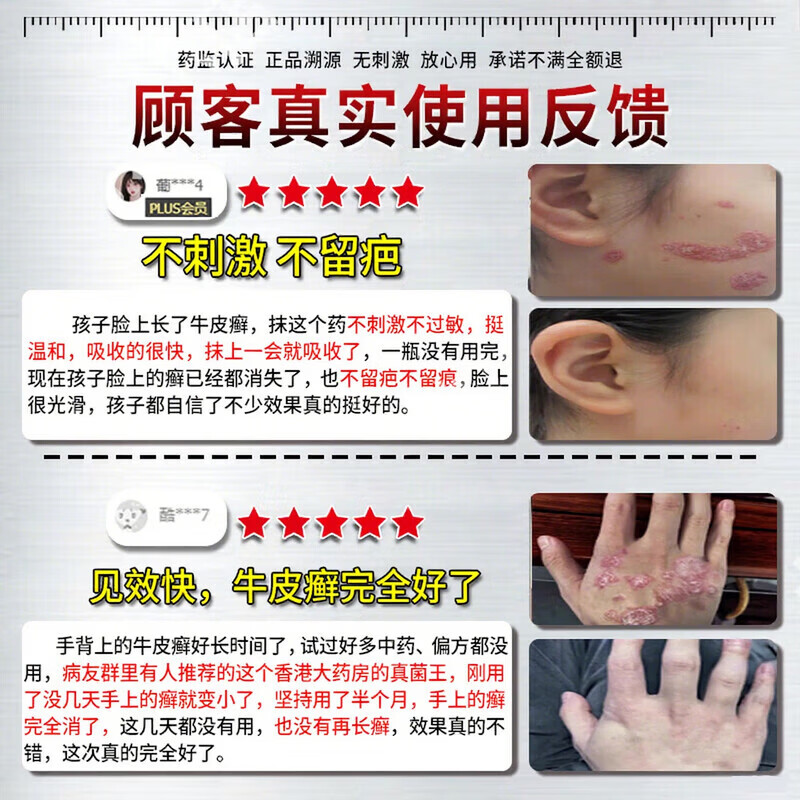 北京协和医学院银屑病药膏生物制剂针顽固皮癣专用真菌止痒皮肤治瘙痒断i根药膏 特强效1盒【一抹見效】原装正品 银屑病牛皮癣皮肤癣专用特强效膏