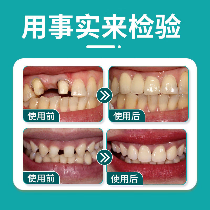 假牙烤瓷牙粘合剂医用牙胶全瓷牙冠牙齿义齿固定粘接剂专用强力胶 顶配款【800%不脱落】全套工具 三甲医院同款永久稳固