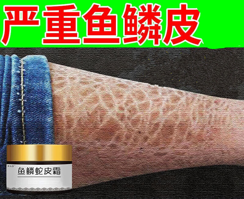 腰间起了很多鸡皮肤(腰间起了很多鸡皮肤疙瘩) 腰间起了很多鸡皮肤(腰间起了很多鸡皮肤疙瘩)