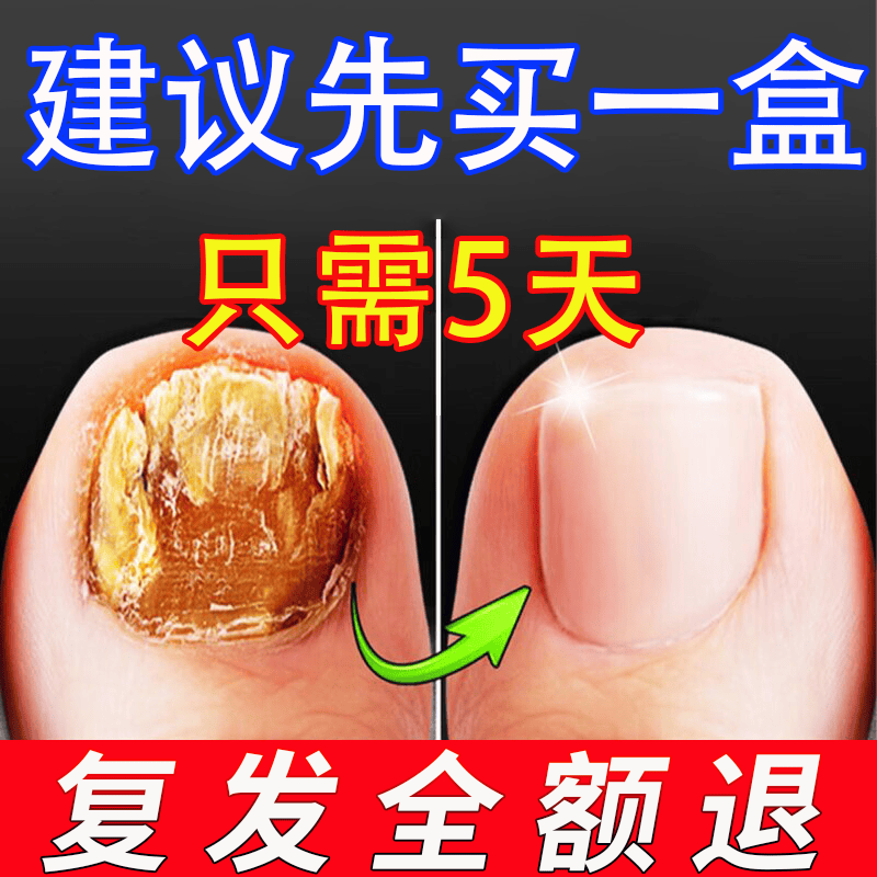国药甄选灰指甲特殊效第1名增厚发黄变空甲中沟草灰甲亮甲凤仙花液 【一个灰甲一盒就行】一盒装 灰指甲100%特效专用的药第一名 京东折扣/优惠券