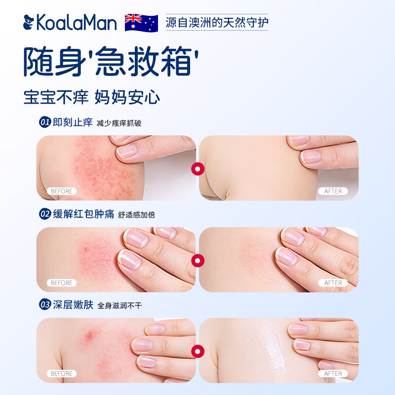 KoalaMan考拉侠澳洲进口儿童止痒舒缓液蚊虫叮咬消包消肿非紫草膏青草膏 0激素护全家 | 50ml两瓶装