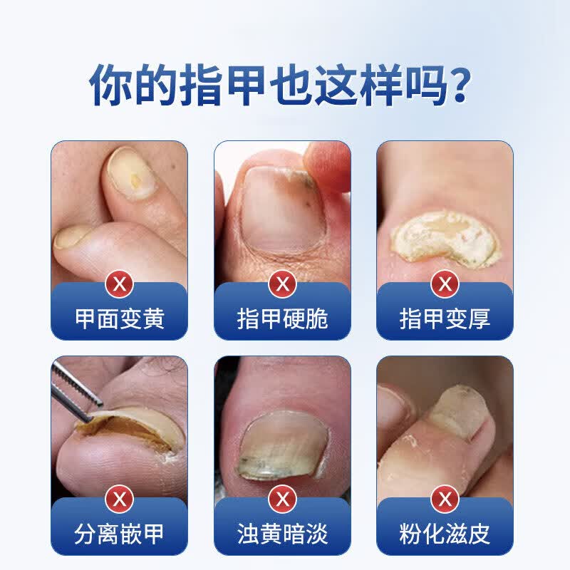 国药药材灰指甲第1名药灰指甲专用指甲真菌感染脱甲坏甲新亮甲根i治护理液 【体验装】1盒