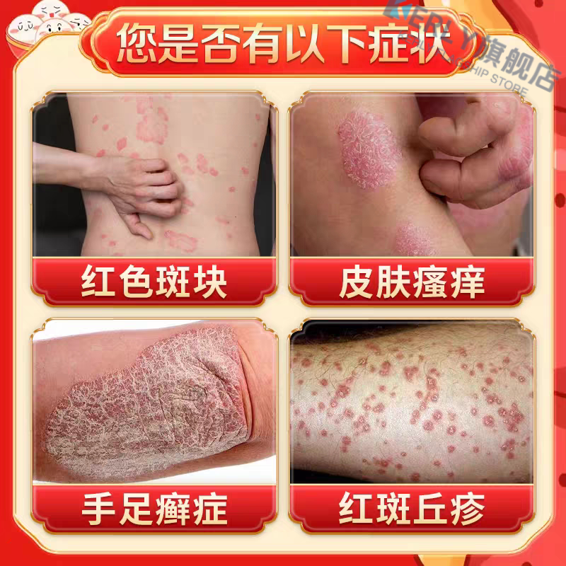 KERLY仲夫子安肤素牛皮鲜银肖白斑红斑瘙痒干燥脱皮认准正品 5盒装 买三赠二【巩固装】96%用户选择 【官方旗舰】