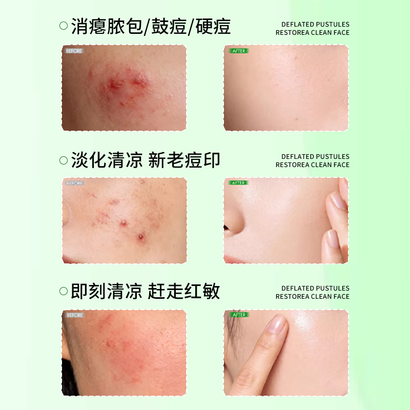 欧姆康祛痘膏专利生物碳祛痘淡化痘印痘坑修护肌肤杀菌学生男女 C 20g-试用装