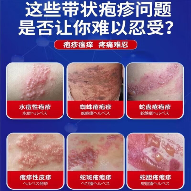 MRYU海澳司康舒元带状疱疹后遗神经痛症药蛇盘疮水痘性疱疹蜘蛛疮正品 5盒装 买三赠二【巩固装】96%用户选择 【官方直售 京质保障】