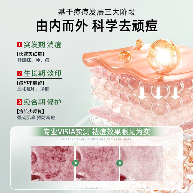 熏姿颜积雪草苷凝乳膏胶法痘痘印去痘坑痘疤修复淡化凝胶精华液消印 5支 买3赠2【巩固装】 【官方旗舰京质保障】