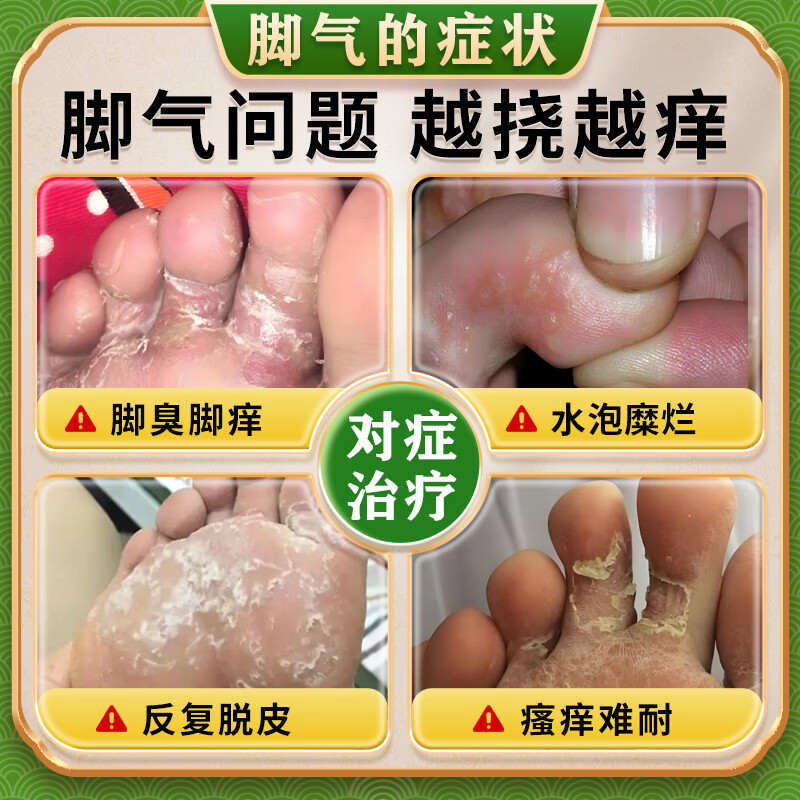 [恒久远]克霉唑乳膏 脚气药膏止痒脱皮烂脚丫真菌感染根药治起小水泡痒脱皮药去脚趾缝烂痒专用【视觉特效 10g 1盒装 【+1盒喷雾 先抹后喷效果更佳】