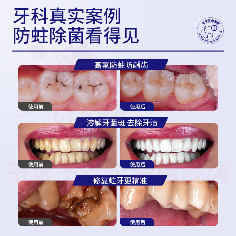 鹿角卉俊小白牙龈i萎缩护理牙膏脱敏牙周i炎减轻牙龈敏感去渍护龈固齿亮 5支装【长效护龈再生】 官方自售