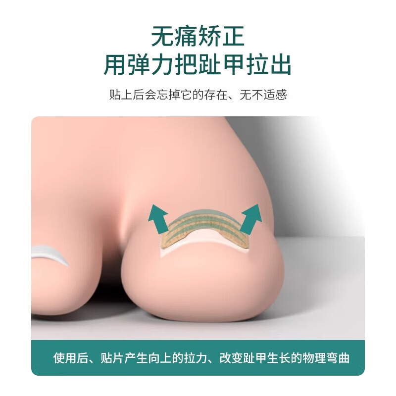 ZYUO甲沟炎器贴片脚指甲长肉里专用正甲贴片甲沟嵌甲器趾甲
100贴【品质保障】 无痛矫正 不再扎肉